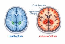 Alzheimer’s Disease: Essential 2026 Guide To Symptoms And Care 49 Medical brain scans comparing healthy brain tissue against alzheimer's-disease related atrophy in the hippocampus and cortex regions.