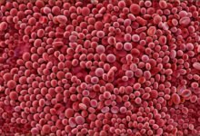 Vitamin Deficiency Anemia: What You Need To Know About B12, Folate, And Healthy Blood (2026 Guide) 42 Vitamin deficiency anemia megaloblastic cells versus healthy red blood cells comparison.